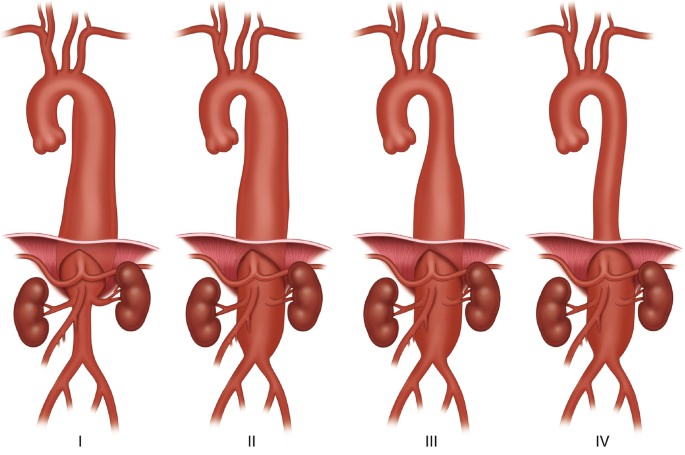 An illustration of the four classifications of thoracoabdominal aortic aneurysms, which are categorized as types 1 to 4. Each has variation in the area of the thoracic and abdominal aorta.