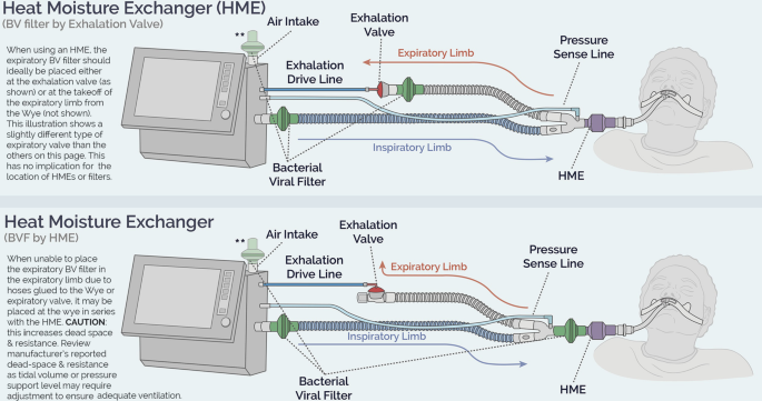 heat moisture exchanger HME placement ventilator circuit
