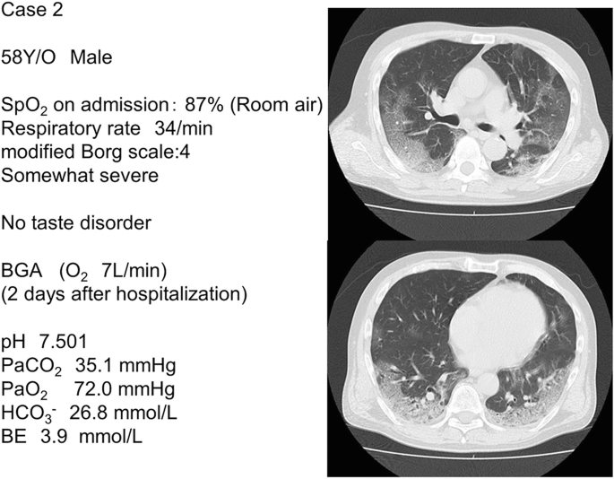 Two C T images of the patient's chest with diffuse pneumonia shadows in the bilateral lung fields. On the left are the details of case 2.