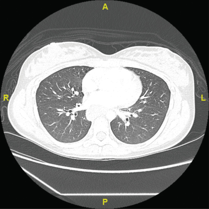 A C T of the chest illustrates the diffuse patchy white spots, in the para hilar region with visible swelling of lymph nodes.