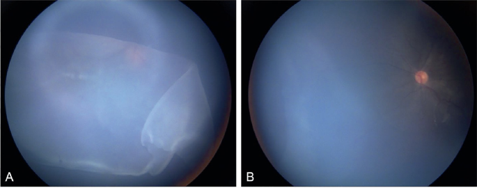 Retinal Tear vs. Retinal Detachment - Monterey, CA - Salinas