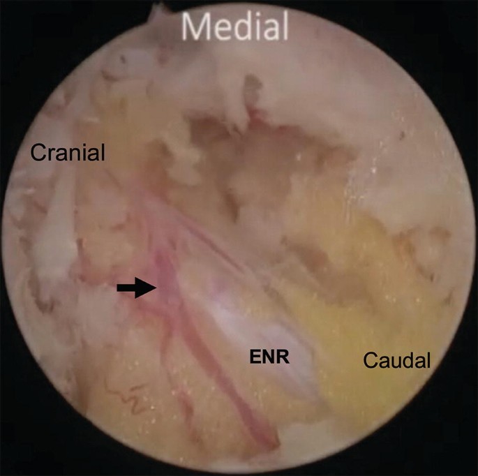 A close-up endoscopic image of an area of the spine has the medial, caudal, and cranial sides marked. An arrow is pointed at the dorsal branch of the segmental artery, and near the exiting nerve root.