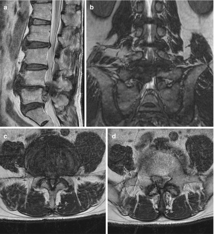 Four pairs of T 2-weighted, M R I scan, endoscopic, and X-ray images, in different planes, of a section of the lumbar spine with a certain type of herniation. The subsequent operation on the concerned areas and their preoperative state are exhibited.