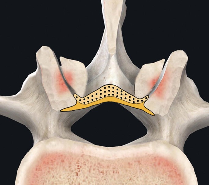 A cross-sectional image of the lamina. A highlighted area at the center represents the 2 layers of L F, external and deeper.