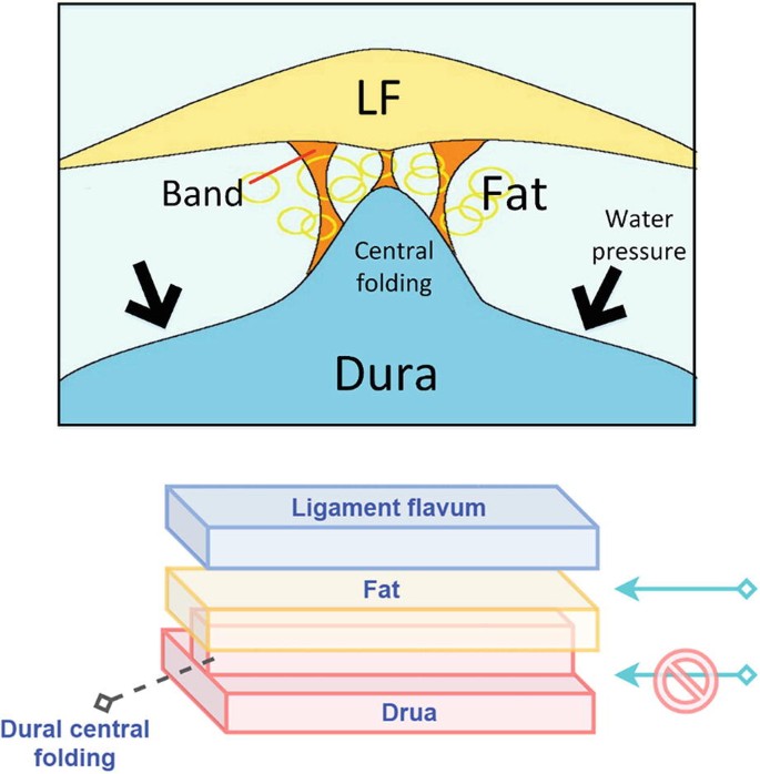 A set of 2 diagrams illustrate the sandwich theory. First diagram marks, L F, band, fat, central folding, water pressure, and dura. The second diagram illustrates the alignment and gaps between these layers. The structure is sandwich-like.