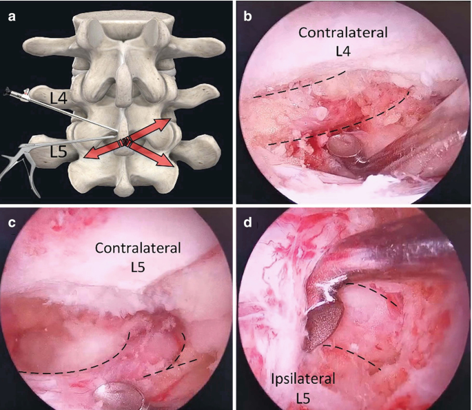 A set of a 3 D image and 3 endoscopic images. The 3 D image is of the spine with arrows of the surgical planning at L 4 and L 5. The 3 endoscopic images showcase contralateral L 4 and L 5, and ipsilateral L 5, with markings for nerve and root decompressed.