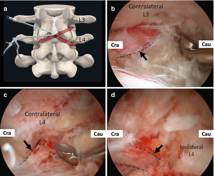 A set of a 3 D image and 3 endoscopic images, a through d. A. Shows the surgical planning for L 3 and L 4 with arrows. C to D. Contralateral L 3 and L 4 with arrows pointing to nerve roots.