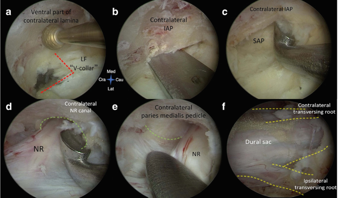 Six endoscopic images of the U B E and U L B D procedure. The labeled parts are the ventral part of the contralateral lamina, L F, contralateral I A P, S A P, N R, contralateral paries medialis pedicle, contralateral transversing root, dural sac, and ipsilateral transversing root. A set of scissors is visible.