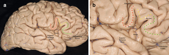 2 photographs illustrate the brain. 1. Markings read superior temporal gyrus, orbitofrontal cortex, and insula. 2. Markings read superior temporal gyrus, insula, anterior horizontal rami, precentral sulcus, anterior ascending rami, and orbitofrontal cortex.