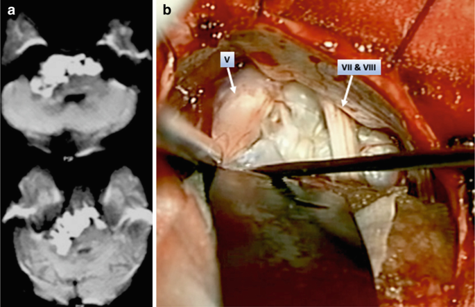 A set of 3 images. Images a and b exhibit the operation of the part using an apparatus. The sinuses are highlighted. Image c is an M R I of the brain.