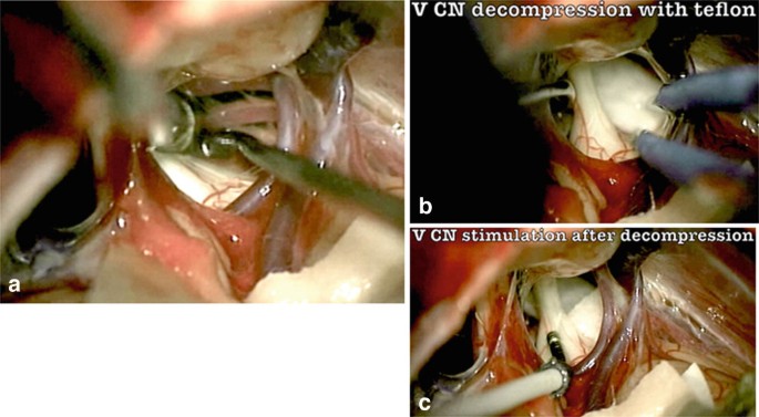 Image a is an M R I scan with linear patches. Image b is a surgical view using medical instruments. Nerves 5 and S C A are highlighted.