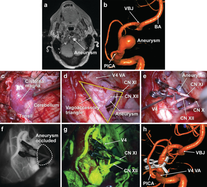 . Journal of comparative neurology . Fig. 11 Parasagittal section near  median surface of mandibular nerve, embryoof pig 17 mm. in length. E,  eustachian tube; Jug, jugular vein; Man, mandibu-lar nerve; Ot, otic  ganglion; *S, semilunar ganglion. Fig. 12