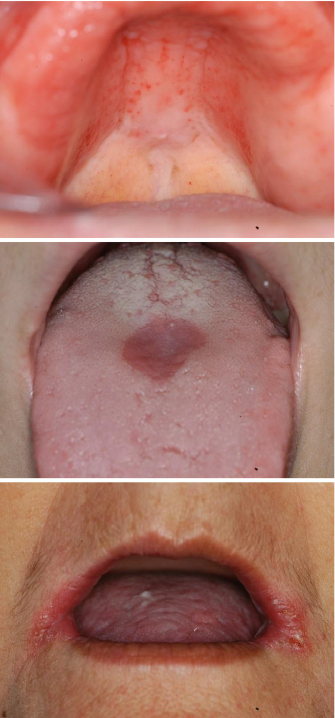 Thrush in men (male candidiasis): Symptoms and treatment, image size:685x1468