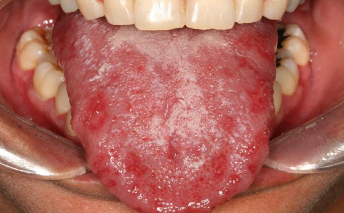 Oral Herpes | SpringerLink