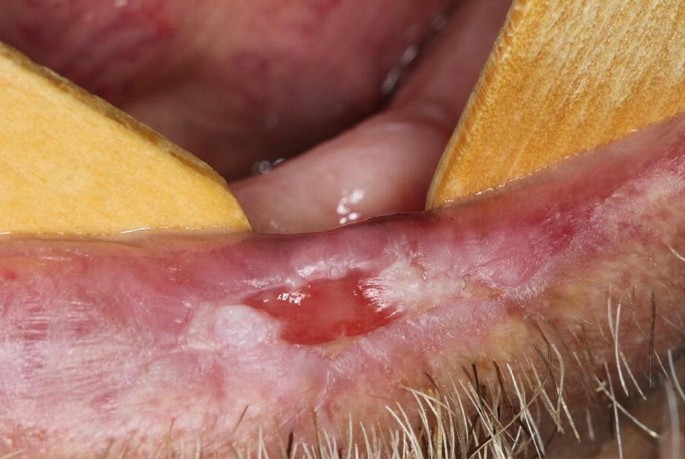 A photo of a magnified view of the lower lip with red patches.