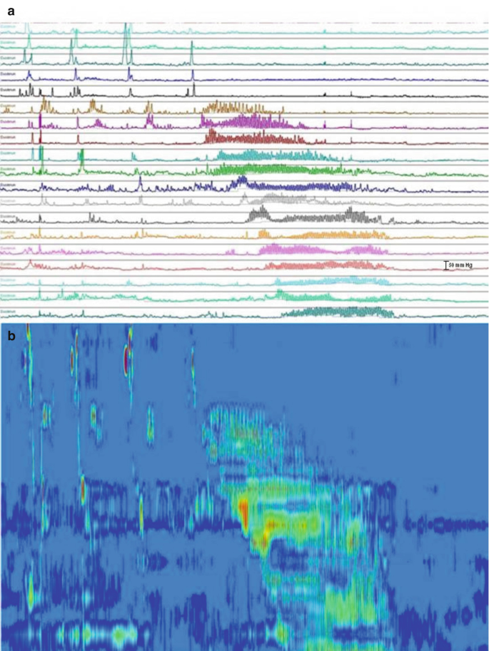 A pair of plots of various fluctuating waveforms that represent the rhythmic contractions of the gastrointestinal tract, with a gradient of colors.