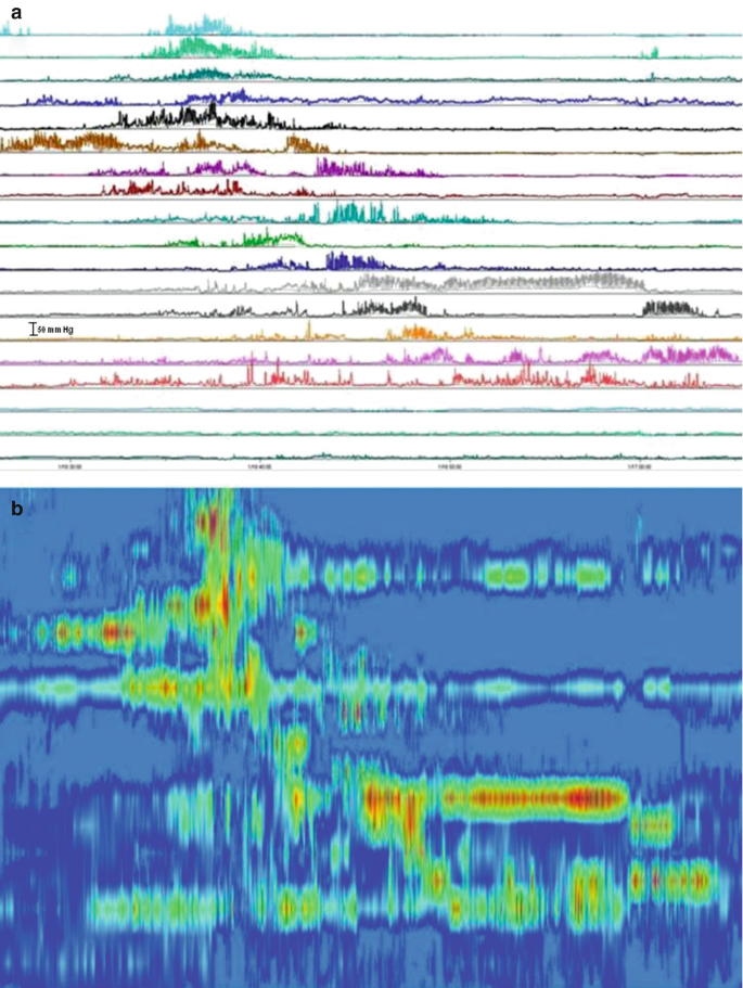 A pair of plots of various fluctuating waveforms that represent the abnormal conditions of enteric neuropathy, with a gradient of colors.