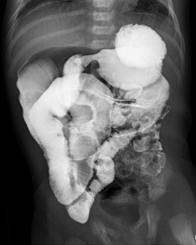 An X-ray of the abdomen. A small bowel follow-through illustrates the malrotation, narrowed pylorus, and enlarged bowel.