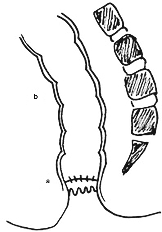 A sketch diagram depicts end to end anastomosis with two parts.