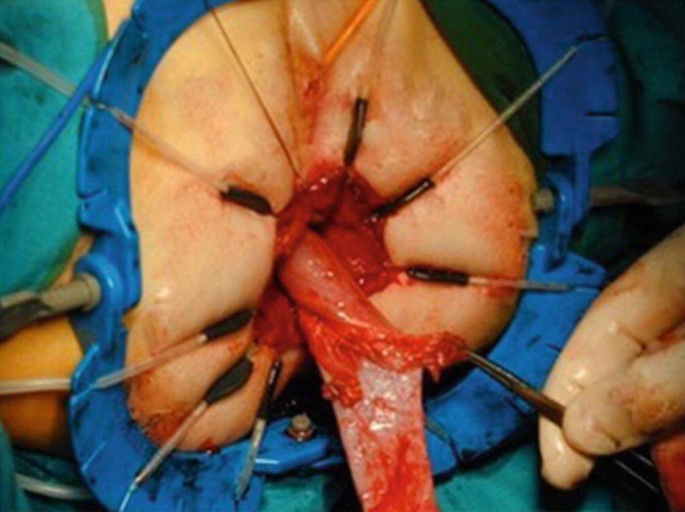 A photograph illustrates a surgical process in the rectum.