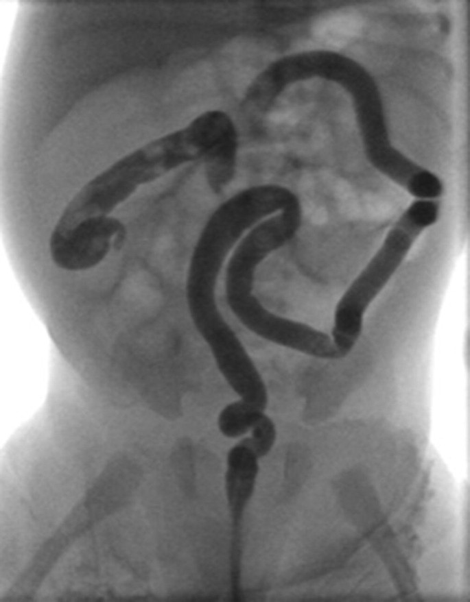 A photograph of colonic aganglionosis.