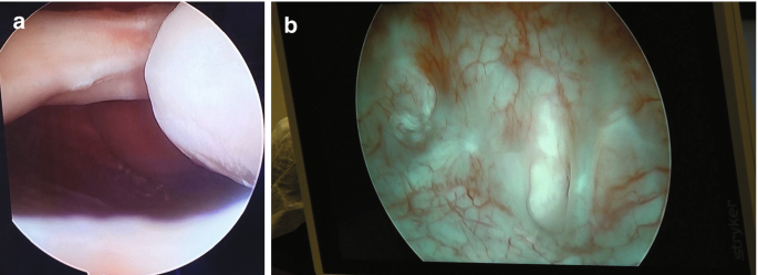 Two cystoscopic views of the bladder via the vagina. A, view of an opening. B, a close-up view with a network of vessels.