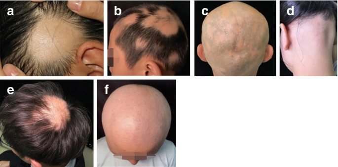 Alopecia | SpringerLink