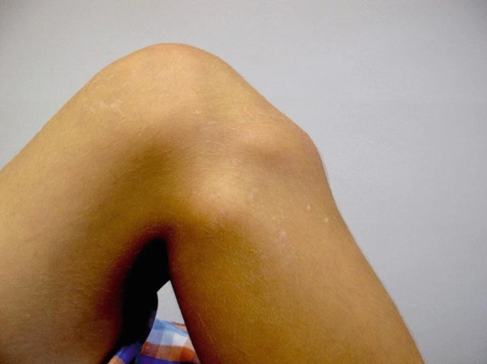 A photograph of a knee with the Osgood Schlatters syndrome. The knee is dislocated, and the tibial tubercle swelling is marked.