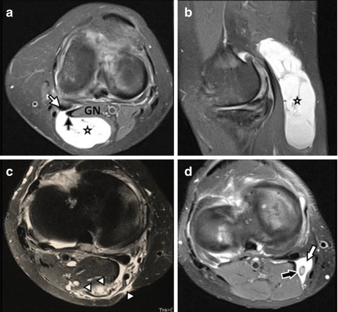 The axial and saggital views of four fat-saturated proton density-weighted images depict the locations of the Popliteal cysts.