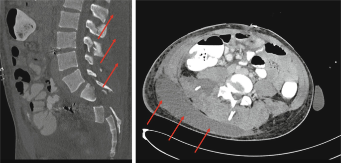 Two CT scans between different skin layers depict the location of the Morel-Lavallee lesion occurring deep to a subcutaneous plane.