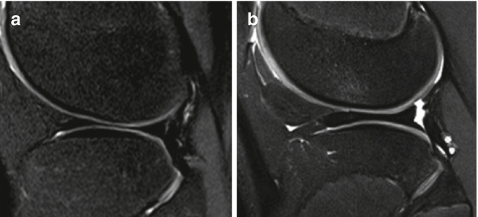 A scanning image of the lateral meniscus in a normal, discoid is marked as a, and b horizontally.