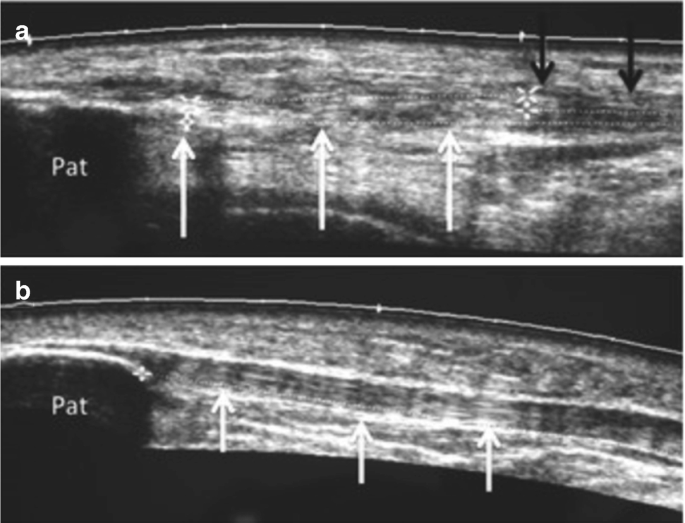 2 ultrasound images illustrate the proximal patella, and patellar tendon arranged vertically marked as a, and b.