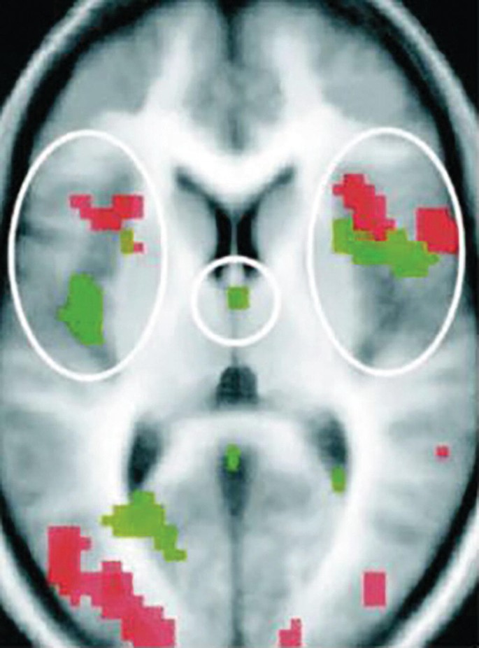 An f M R I scan image of the brain of a patient with encircled multicolored clusters from regions in the left, center, and right.