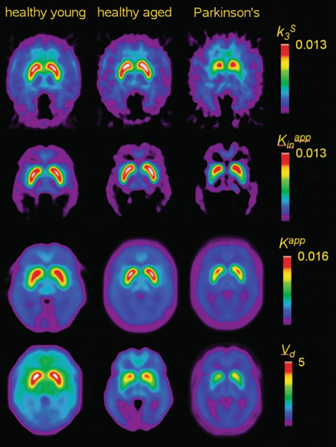 3 sets of 4 mean parametric maps, in different planes, of the brain of 3 different people via k subscript 3 superscript s with spectrum up to 0.013, K subscript in superscript app up to 0.013, K superscript app up to 0.016, and V subscript d up to 5. Most activities happen in a young person's healthy brain.