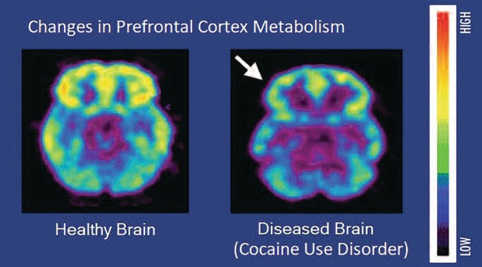 A set of two brain images of changes in prefrontal cortex metabolism. a. healthy brain. b. A diseased brain for cocaine use disorder.