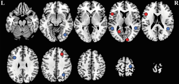 A set of 9 neuroimages represent P T S D patients and non-P T S D controls. A number of 5 and 7 different colored dots are marked on the images.