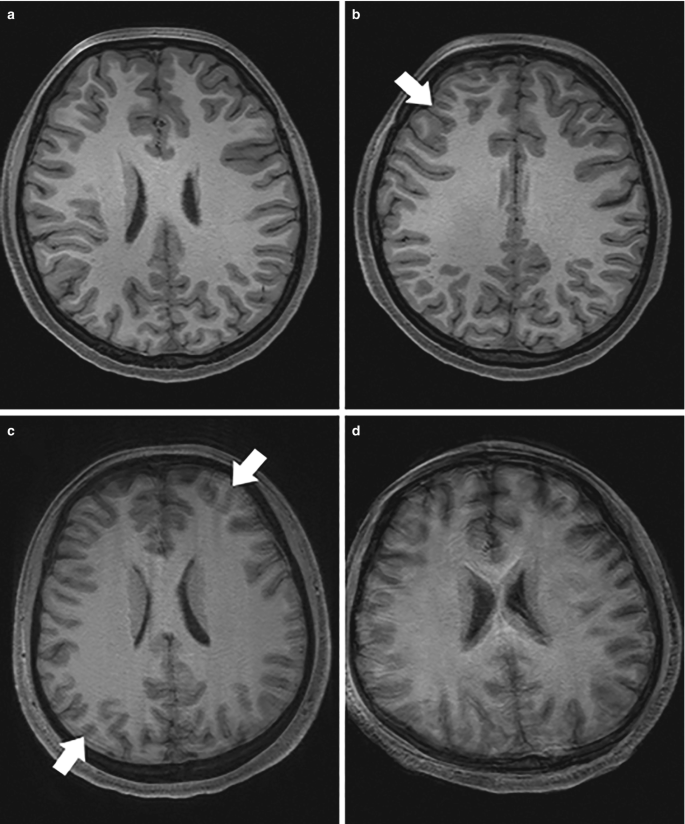 A set of 4 figures depict psychoradiology, anatomical M R acquisition quality control. It includes four categories, a, b, c, and d, which are mild, moderate, severe, and motion artifact. There are arrows to indicate the ring and blur effect.