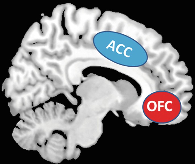 A neuroimage depicts the anatomical brain O C D. It has highlighted labels for A C C and O F C.