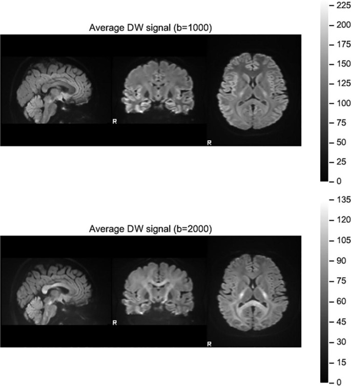 A set of 2 figures with 3 M R I scan each, represent average psychoradiology diffusion M R acquisition and quality control. It has an average D W signal b 1000 and 2000 for the figures respectively.