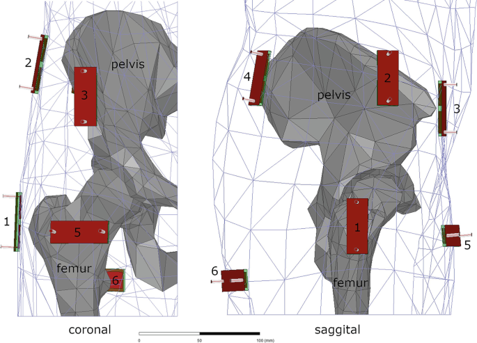 A schematic of the coronal plane is on the left and on the right is the sagittal plane. The pelvis and femur along with antennas are highlighted.
