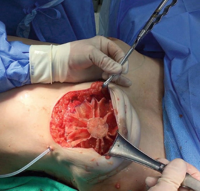 The LOTUS Pre-pectoral Breast Reconstruction | SpringerLink