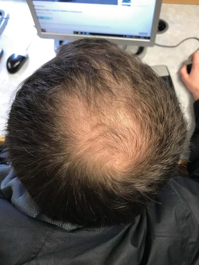 A photo of a top-view of baldness in the center area of a man's head.