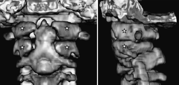 2 X-ray images of the proatlas, one anterior and one lateral. The proatlas bone consists of persistent vertebral rings on the bone surface.