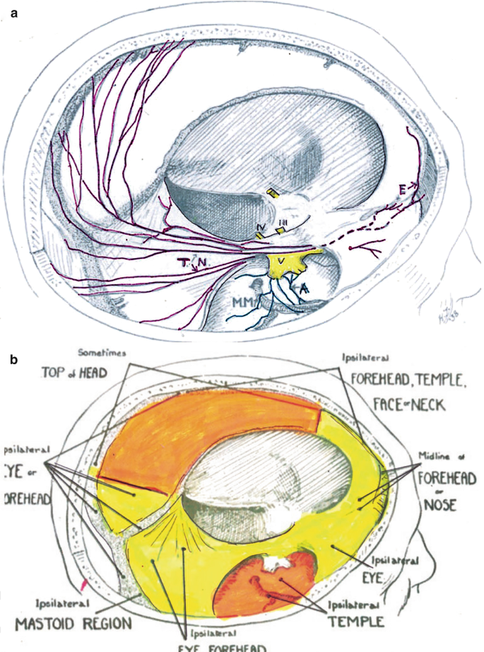 2 diagrammatic representations of the dura pathways. 1. The labeled regions on the pathway are T N, M M, A, V, and E. 2. Some of the labeled regions are the forehead, temple, face, neck, nose, eye, mastoid region, and top of the head.