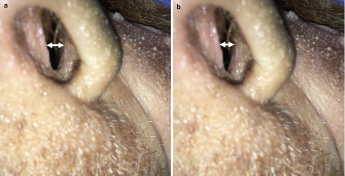 Two photographs of the nasal valve open with muscle retraction and close in a relaxed state.