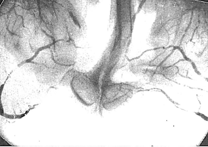 An angiogram of the mouth illustrates the blood supply in the bilateral cleft lip. The paired anterior ethmoid vessels, indicated in the dark shade, demonstrate the blood supply.