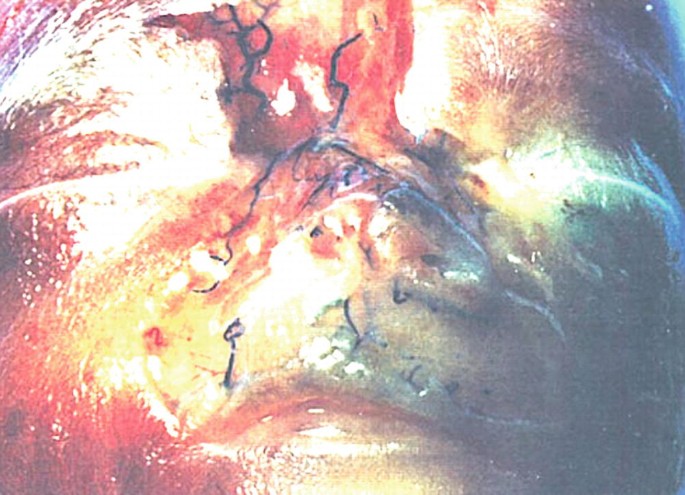 A photograph of the face of a fetus specimen. It illustrates the nasal region. The region has sutured portions of the arteries after the removal of the nasal skin.