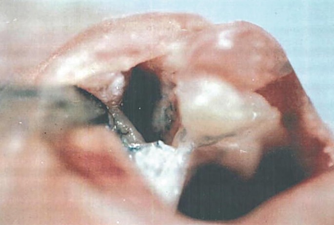 A close-up photograph of the mouth and nose exhibits the unilateral cleft lip and the alveolus.