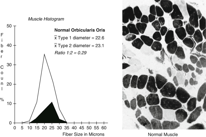 A histogram of fiber count versus fiber size in microns. The title of the graph reads muscle histogram. x type diameter = 22.6, x type 2 diameter = 23.1 ratio 1 ratio 2 = 0.29. An illustration depicts the normal muscle.