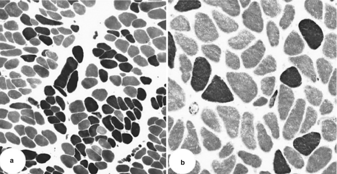 2 micrographs illustrate the fiber type in the cleft palate. 1. The L N P with cleft type with a large proportion of tissue in dark and light shades is indicated. 2. L V P in the normal adult with light and shaded fibers.